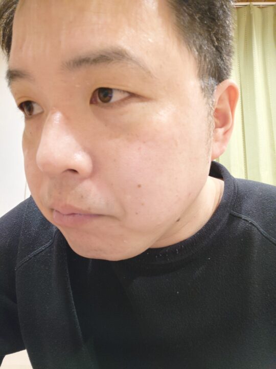 炭酸パックアフター